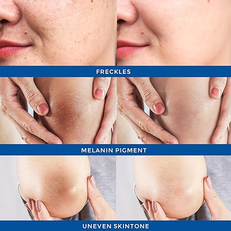 Leâ€™phoqua Dark Spot Corrector for Face and Body, Sun Spot Corrector, Age Spot Remover For Face, Inner Thighs, Hands, Intimate Areas, Dark Spot Remover