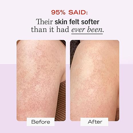 First Aid Beauty KP Bump Eraser Body Scrub Exfoliant for Keratosis Pilaris with 10% AHA â€“ 2 8oz Tubes, 16 oz Total